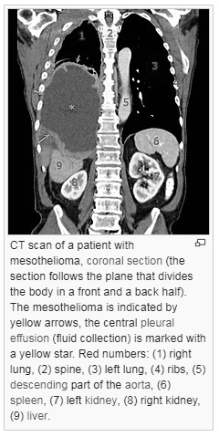 What is mesothelioma poster Images