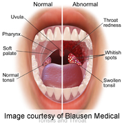 Throat cancer symptoms explanation images