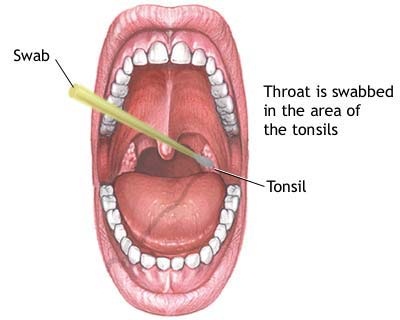 Throat cancer symptoms explanation images